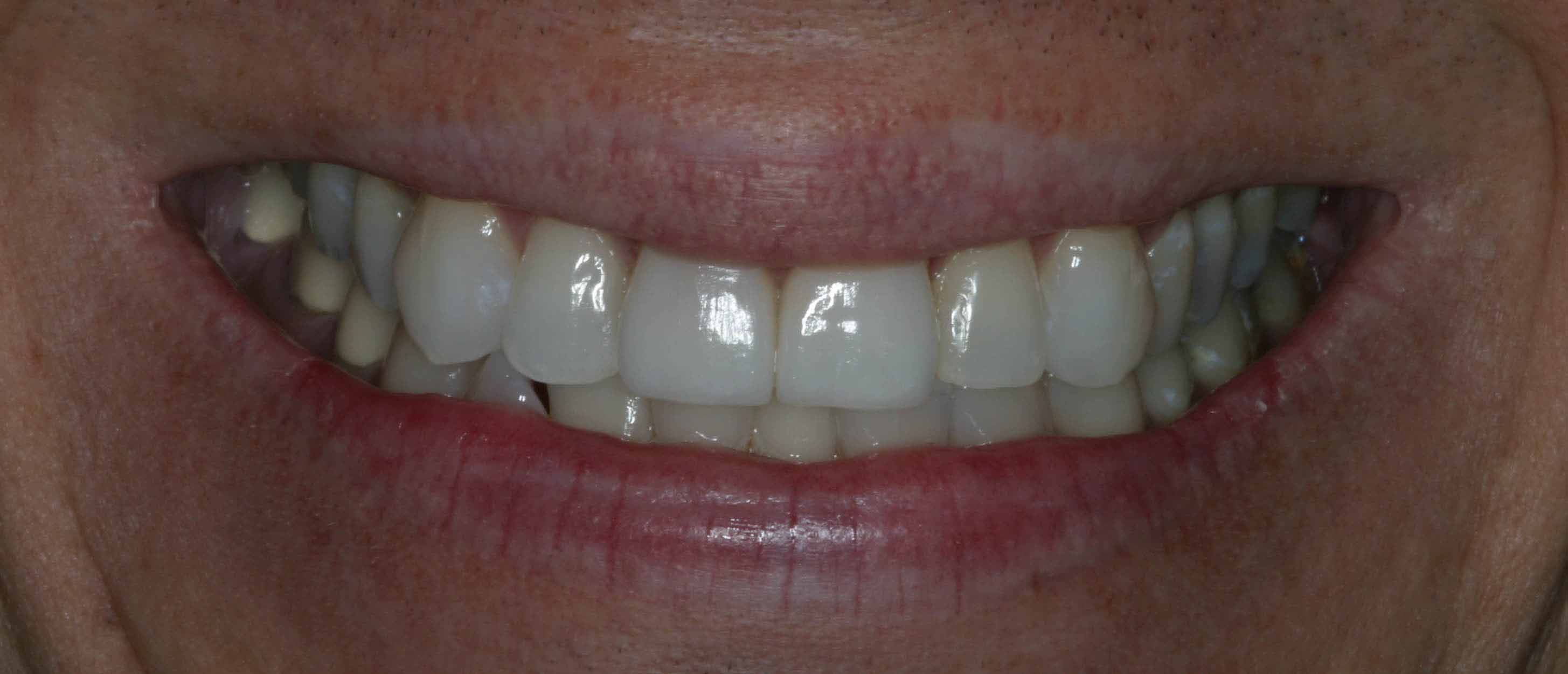 Two veneers