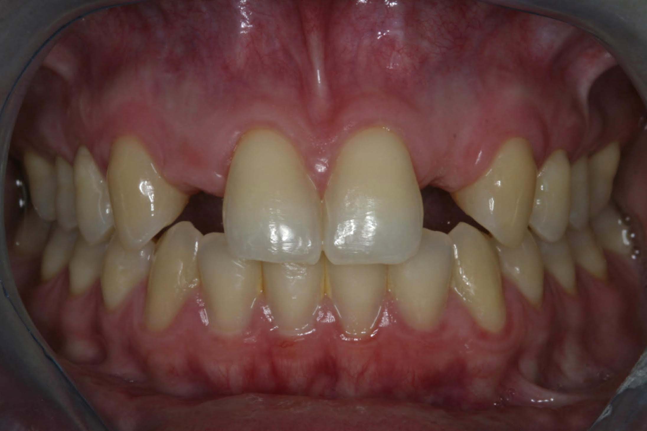 Before smile with two missing lateral incisors