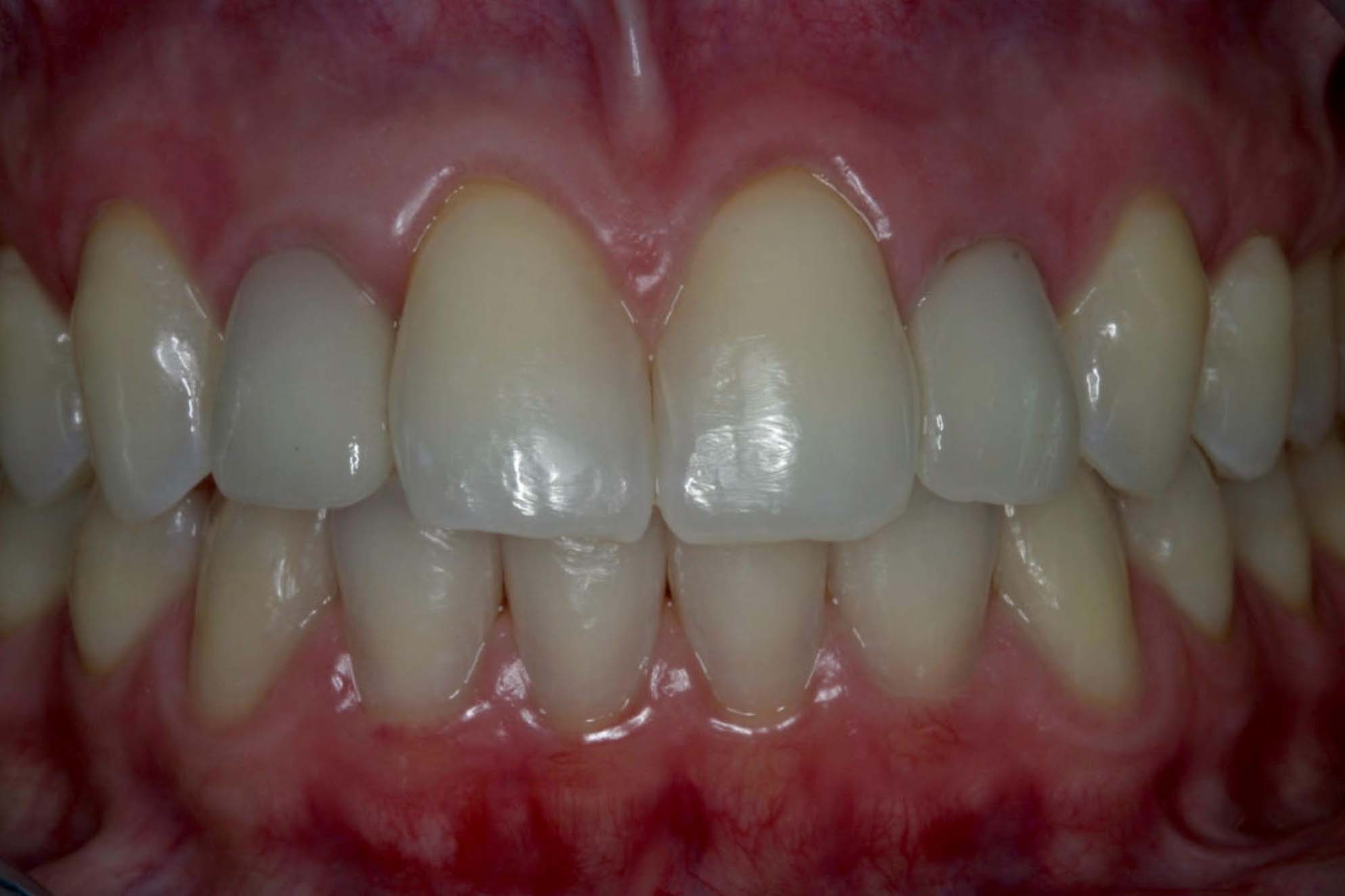 Very nice smile after with two dental implants